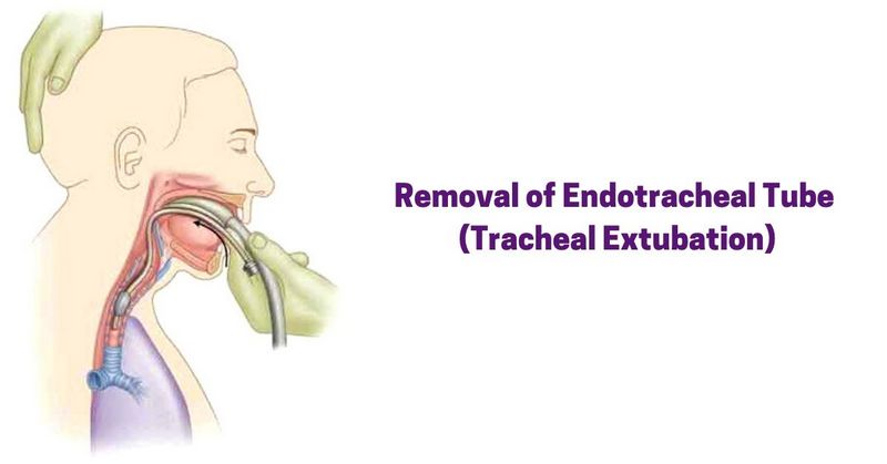 Removal of Endotracheal Tube (Tracheal Extubation)