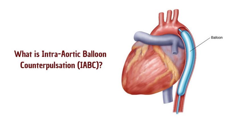 What is Intra-Aortic Balloon Counterpulsation (IABC)